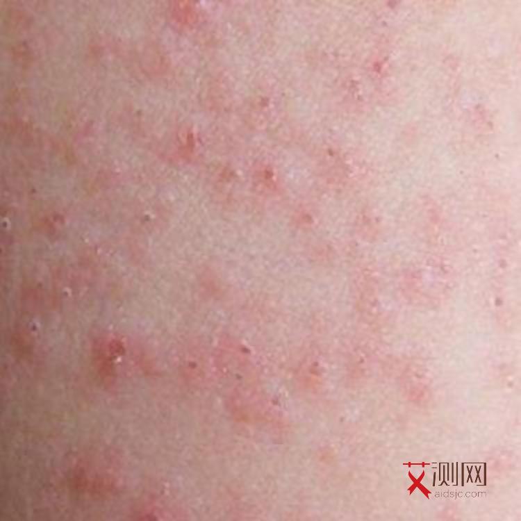 艾滋病死亡人数2023