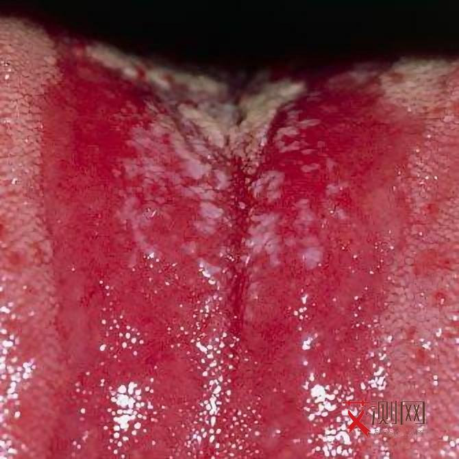 艾滋病症状多长时间出现一次表现正常呢图片男