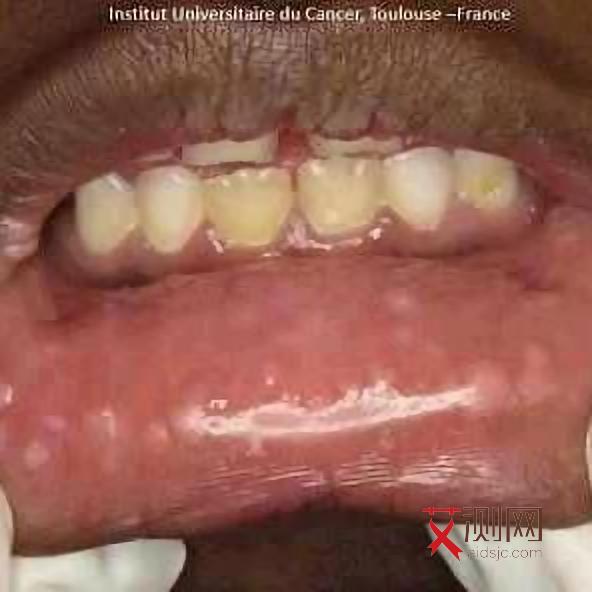 艾滋病怎样治疗不会传染给家人