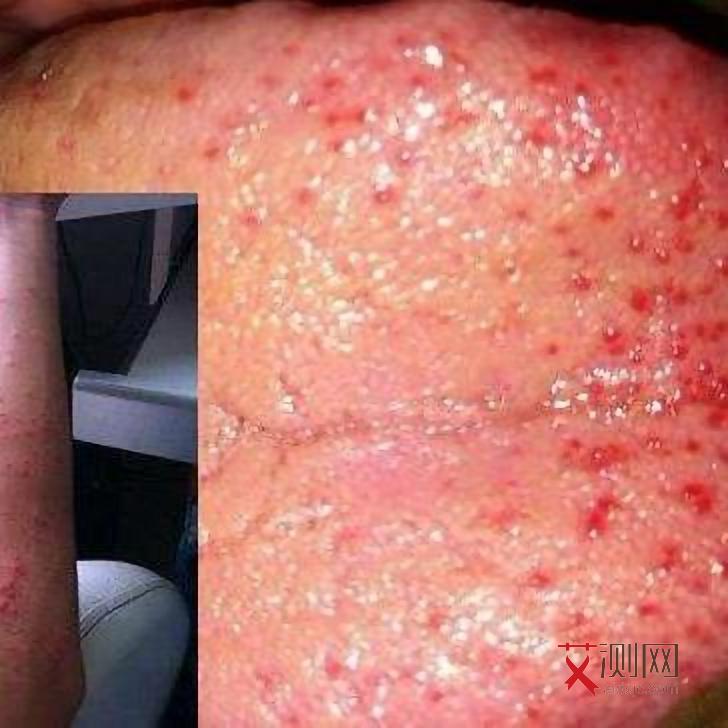 艾滋病会持续发烧多久