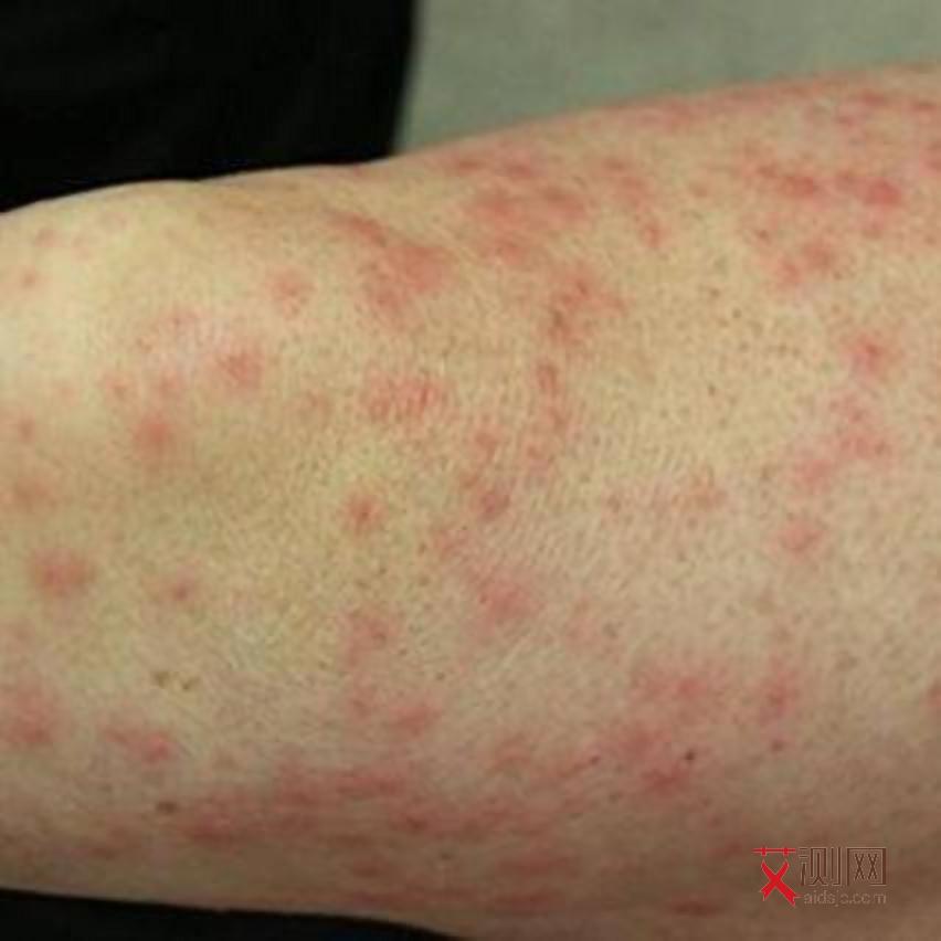 怎么判断自己是否得了艾滋病