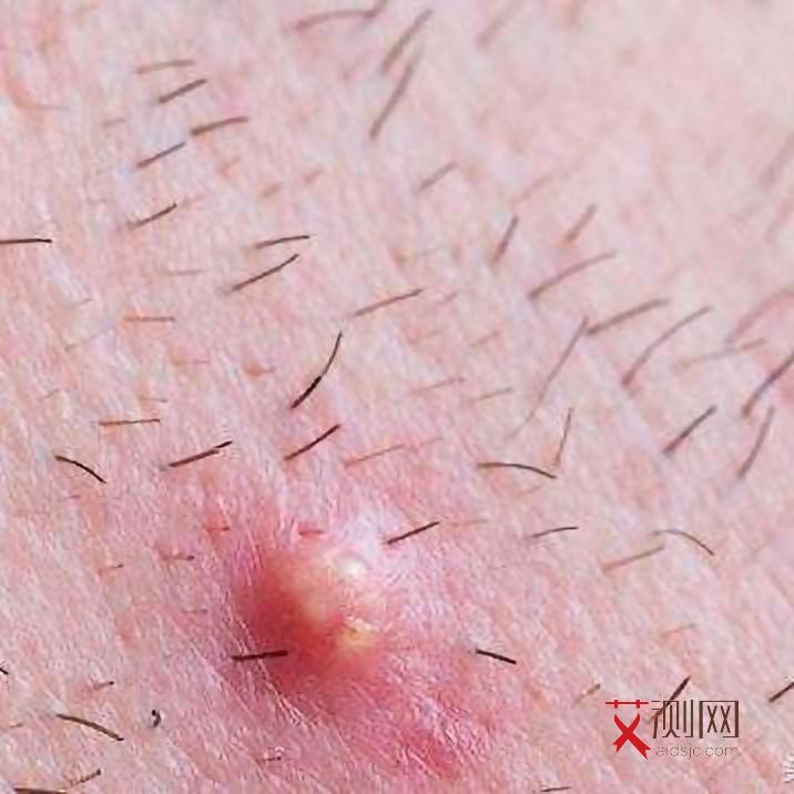 艾滋病女性表现有哪些特征