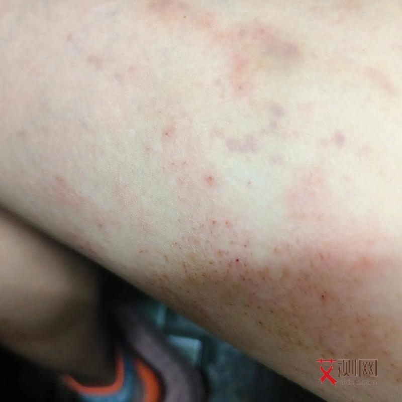 艾滋病多久能查出来一般需要几周