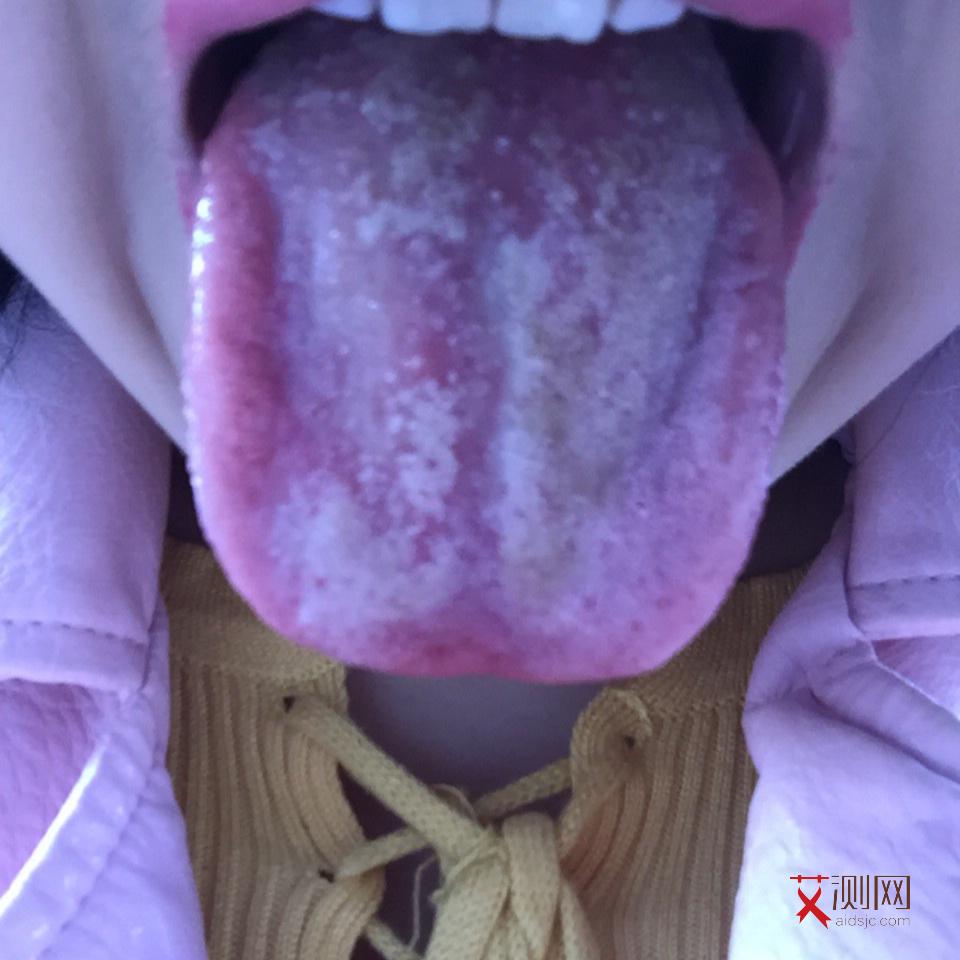 艾滋病的皮肤溃烂会烂几年吗图片