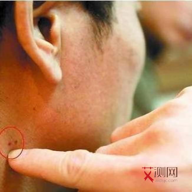 艾滋病什么症状表现男性女性多