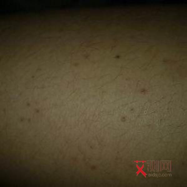 艾滋病女症状有哪些表现和症状图