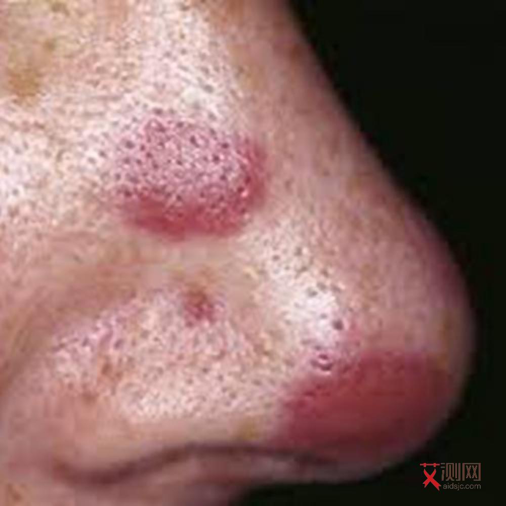 艾滋病的人什么症状