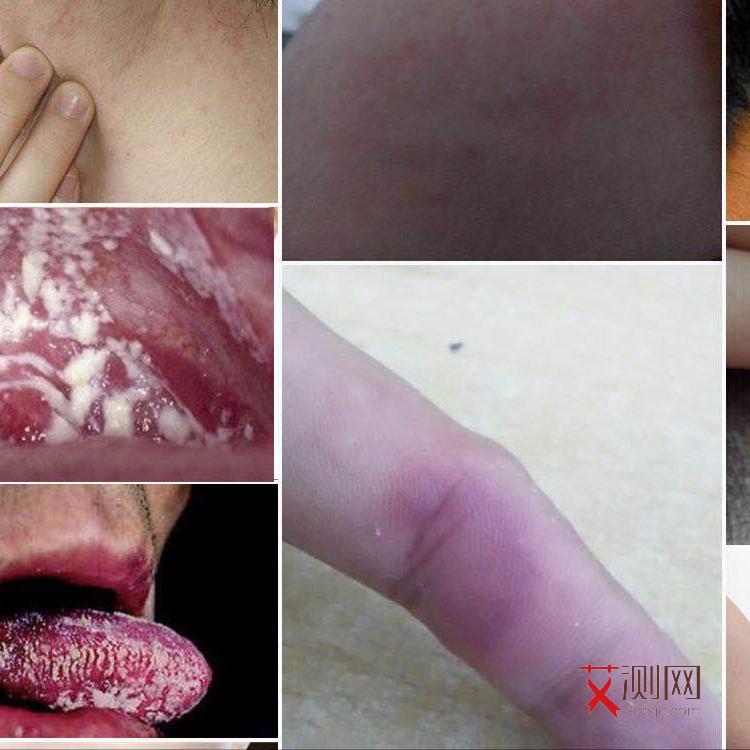 出现艾滋病会有什么症状图片女性