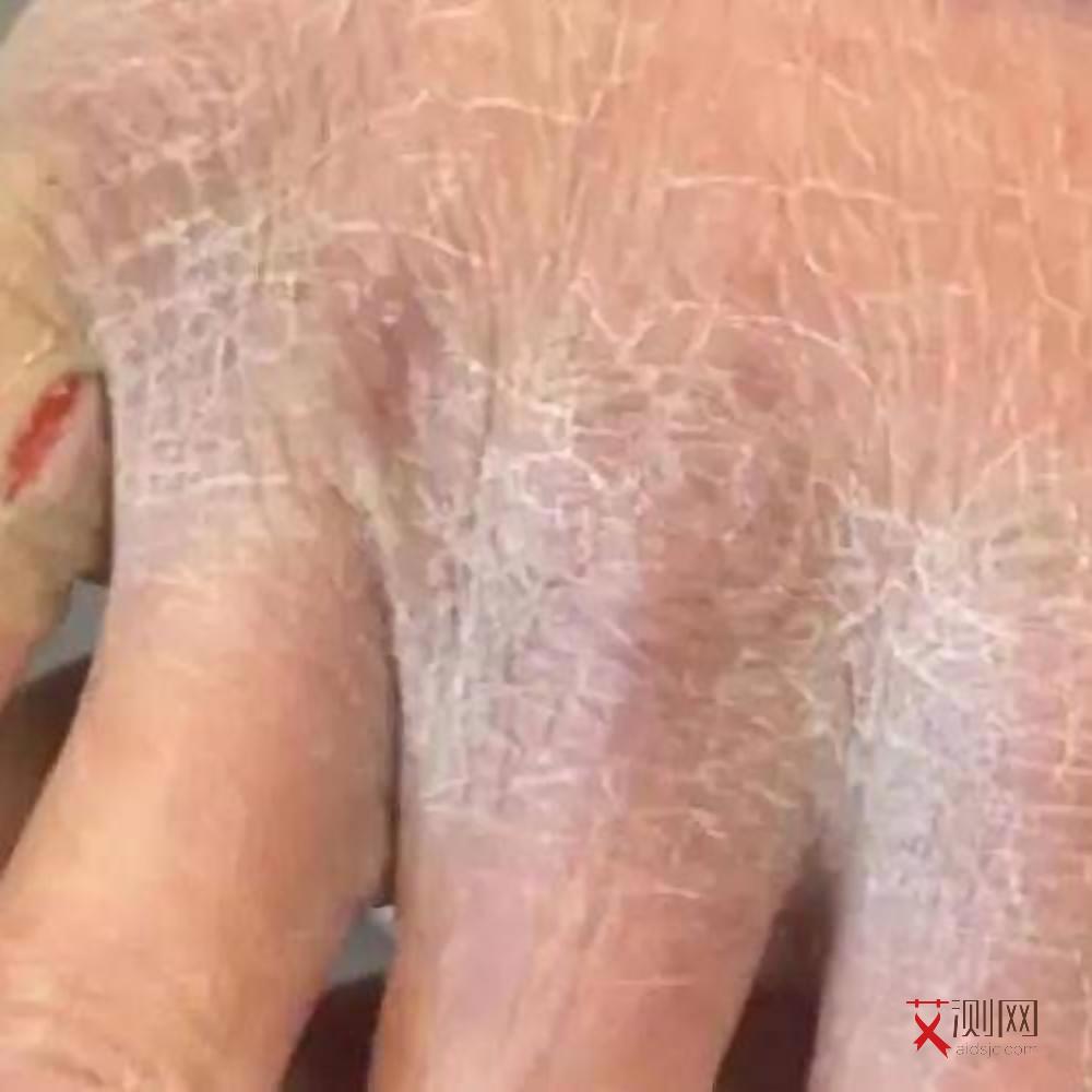 感染艾滋病有救吗能活多久