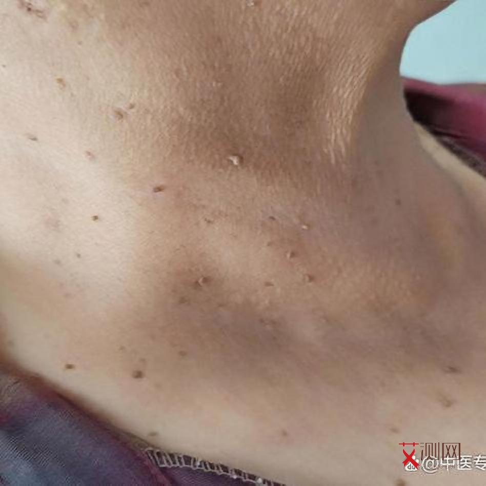 艾滋病已经出现并发症能活多久