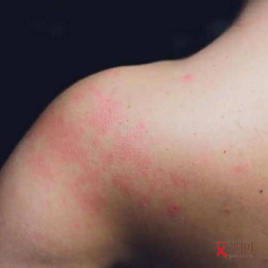 感染了艾滋病可以活多久啊女性