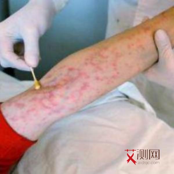艾滋病皮肤开始溃烂说明发病了吗图片大全