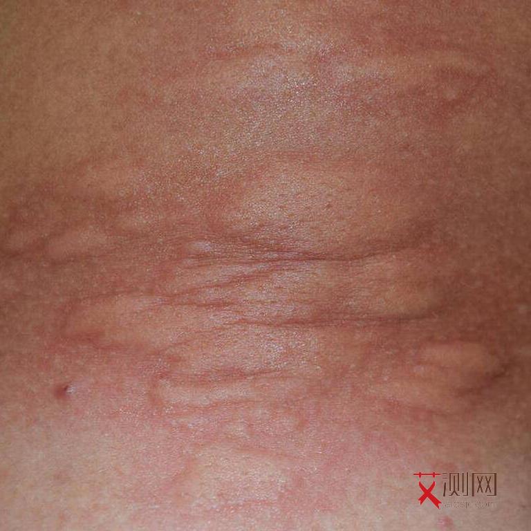 艾滋病会持续发烧多久