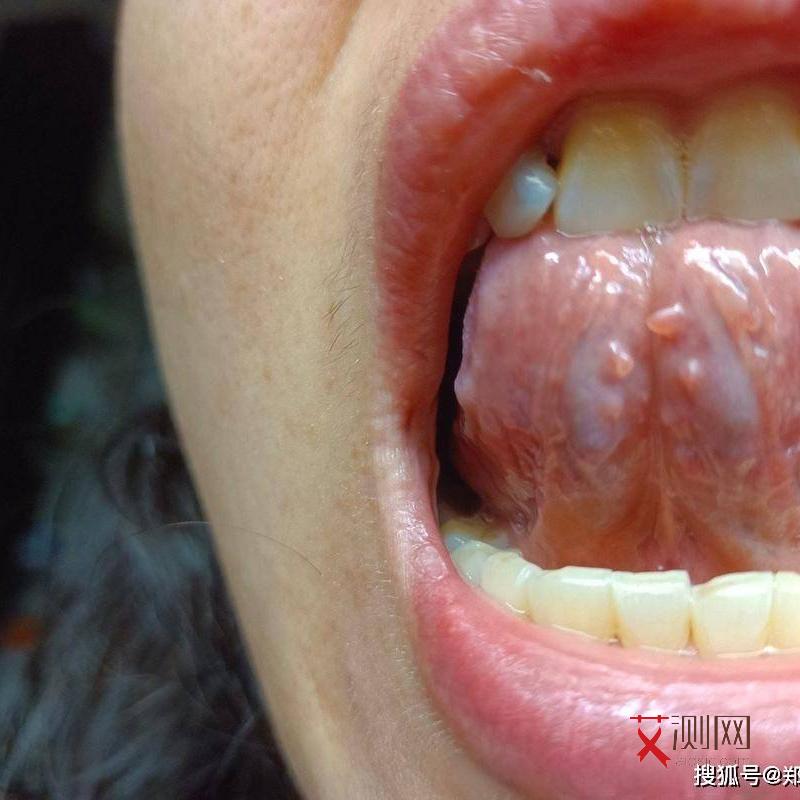 艾滋病引起淋巴肿大了危险吗