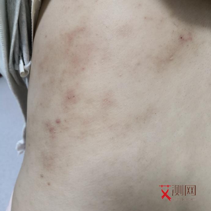 男性艾滋病毒下面有什么症状图片