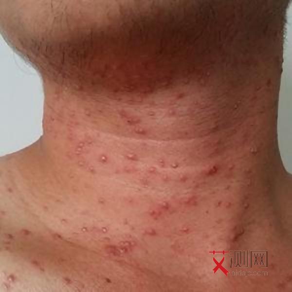 艾滋病早期症状多长时间消失正常