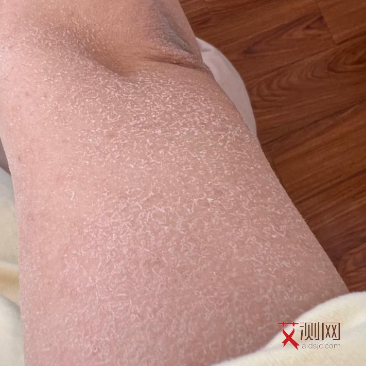 艾滋病有何表现症状男性