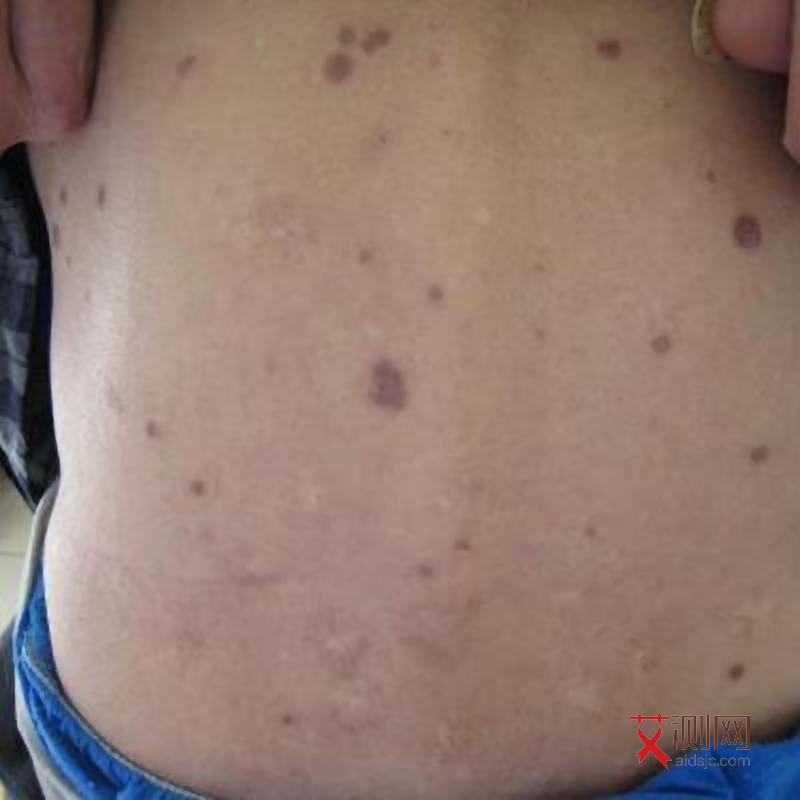 艾滋病早期主要症状有哪些表现