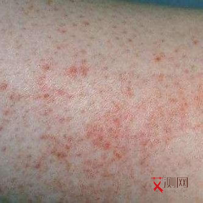 刚感染艾滋病什么症状会出现