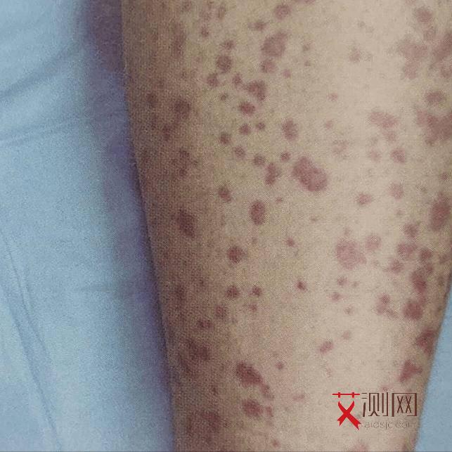 艾滋病患者最明显的症状是哪种症状呢