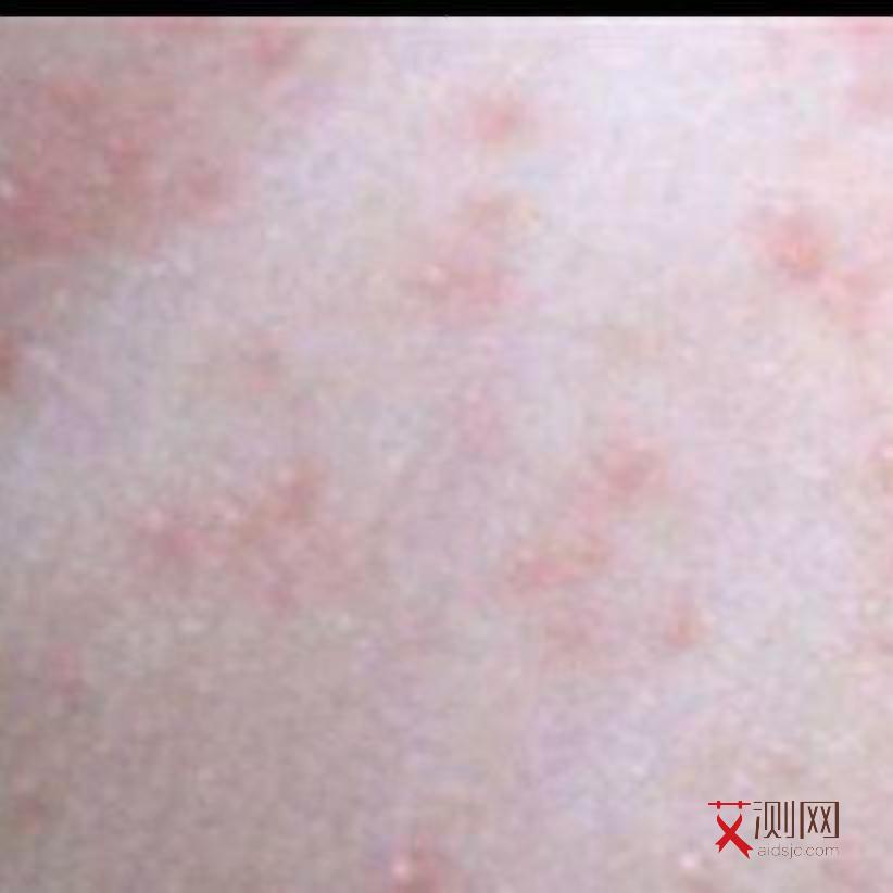 男性艾滋病患者症状