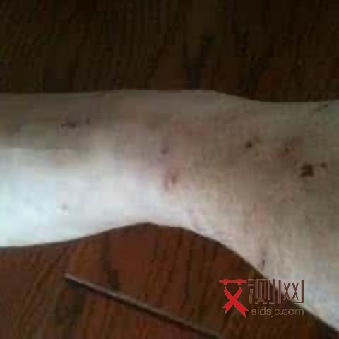 艾滋病皮肤溃疡用赛霉安散有用吗会传染吗