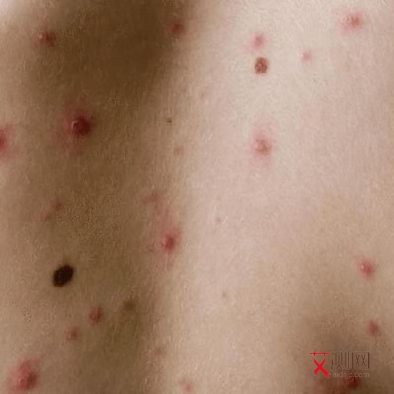 男性艾滋病初期症状是什么样的图片和症状