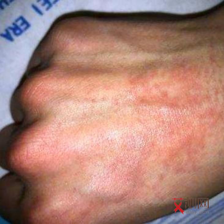 女性艾滋病皮肤症状