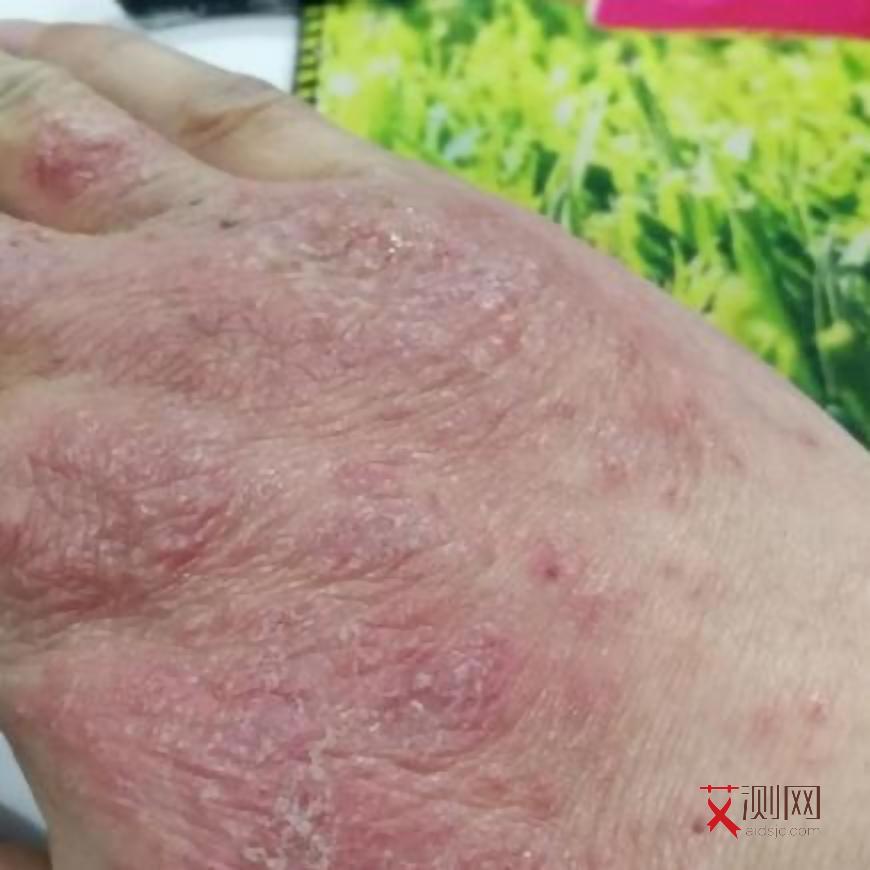 艾滋病女性生殖器,瘙痒几天能好转