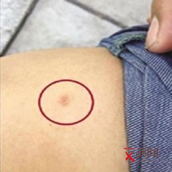 艾滋病的初期会不会有皮肤过敏现象