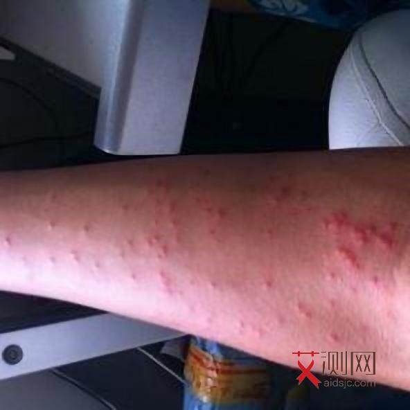 艾滋病发热在什么时候