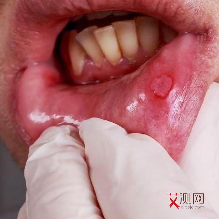 艾滋病初期脸上长痘痘图片女