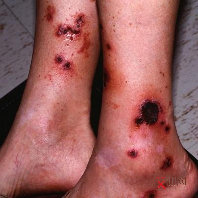 女人艾滋病皮肤症状表现图