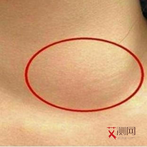 艾滋病初期的红疙瘩会疼吗会痒吗