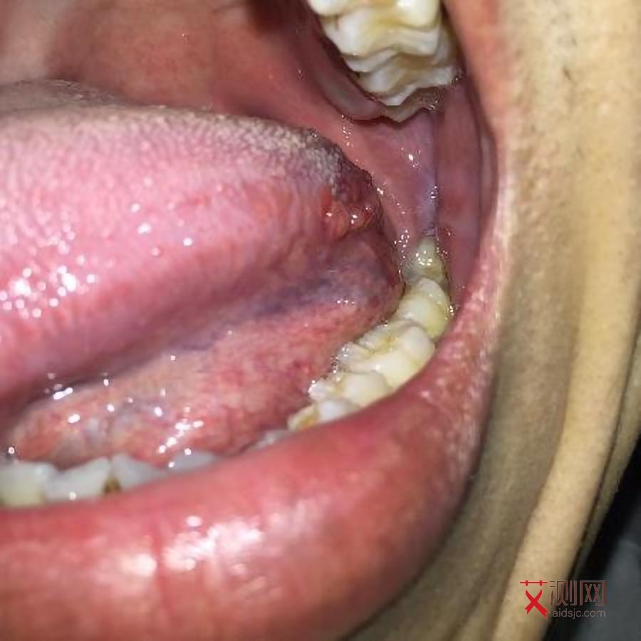 艾滋病小红点会不会凸起