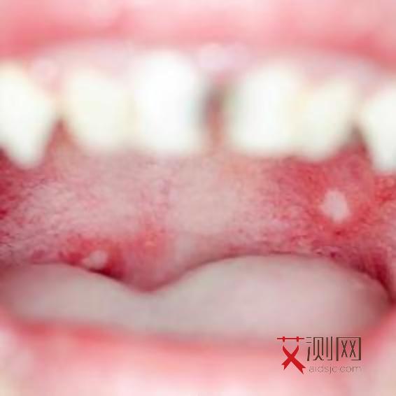 艾滋病通过牙齿出血感染的概率有多大