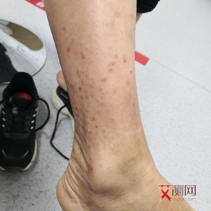 艾滋病一天会有什么症状吗女性