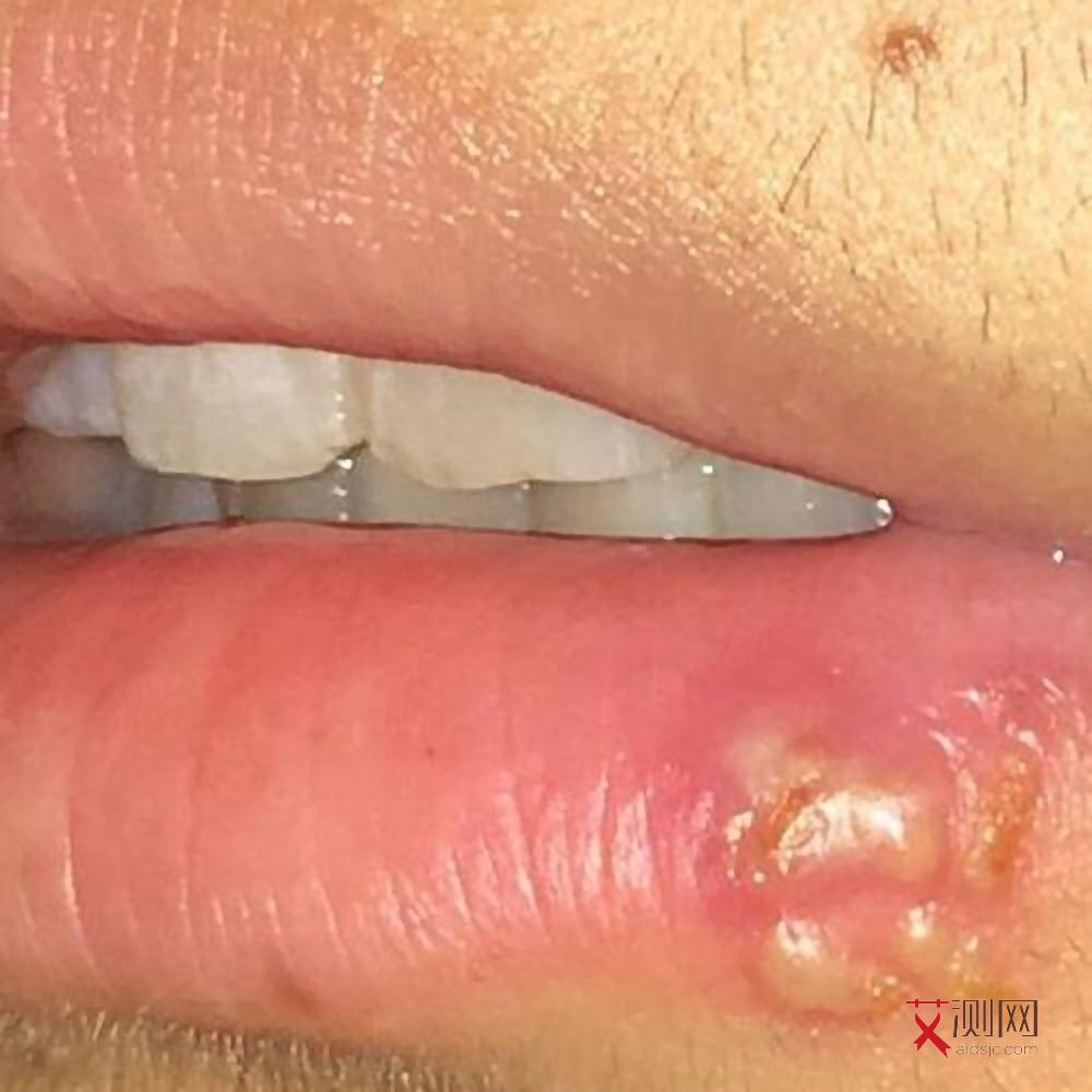 艾滋病咽喉痛特点