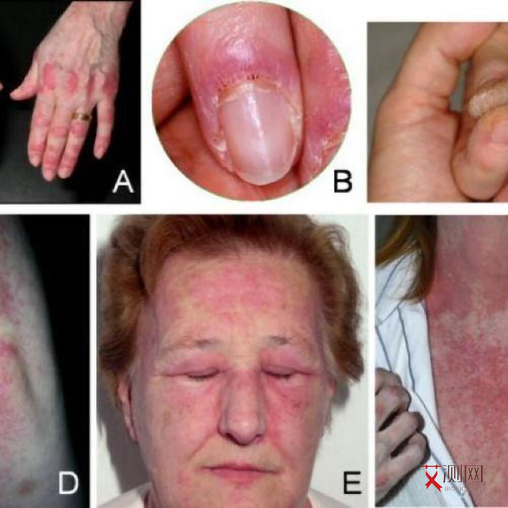 艾滋病早期患者图片大全大图