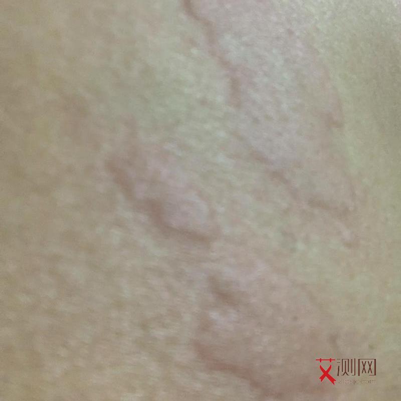 怎么检测是否有艾滋病病毒感染