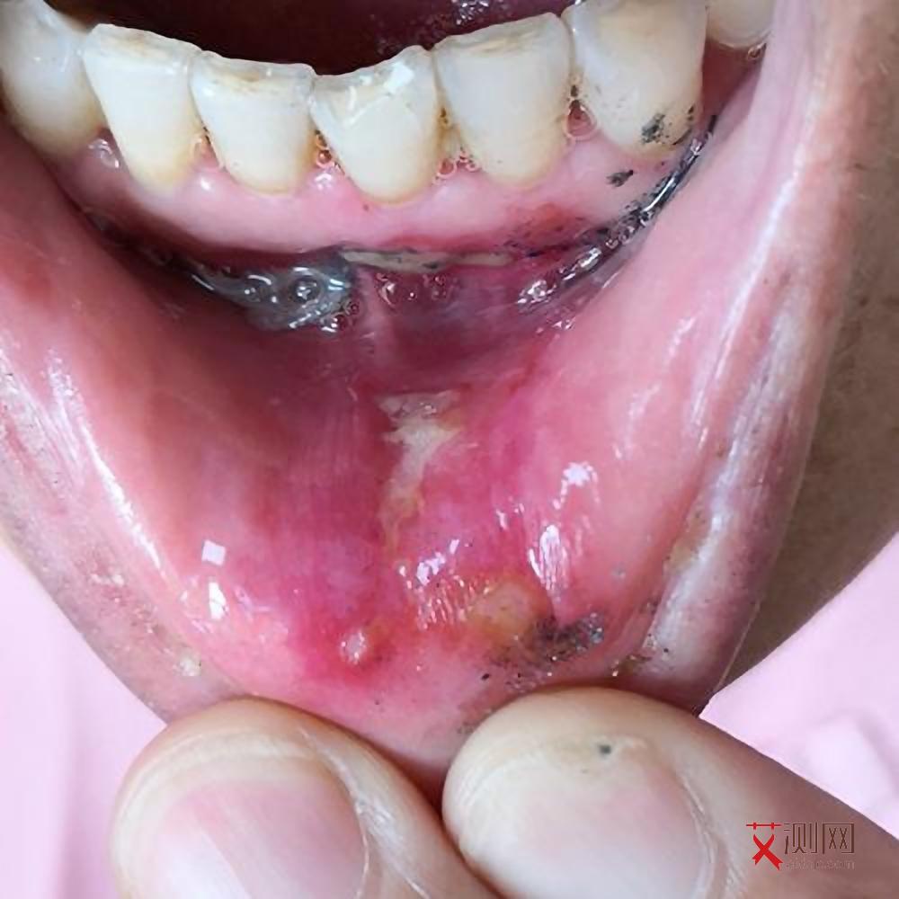 艾滋病身上起红疙瘩吃什么药