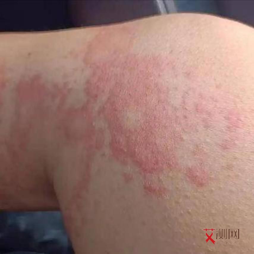 艾滋病女性表现几天出现正常吗会传染吗