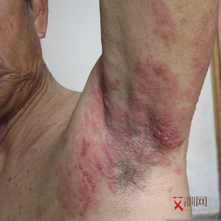 艾滋病的人下面味道大吗会传染吗女性