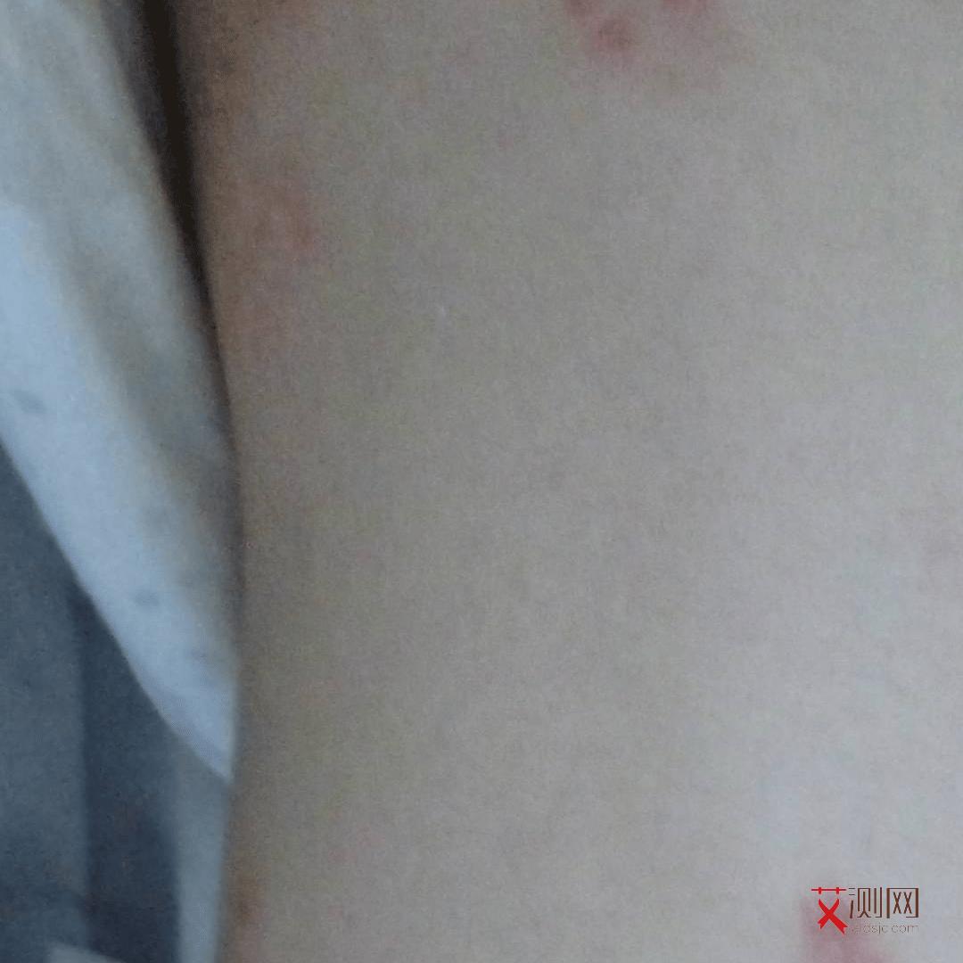 艾滋病症状及治疗原则是什么