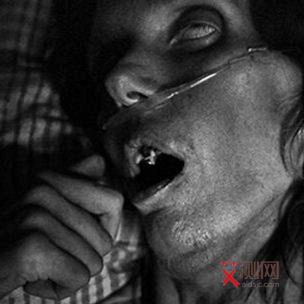 艾滋病的病人的图片
