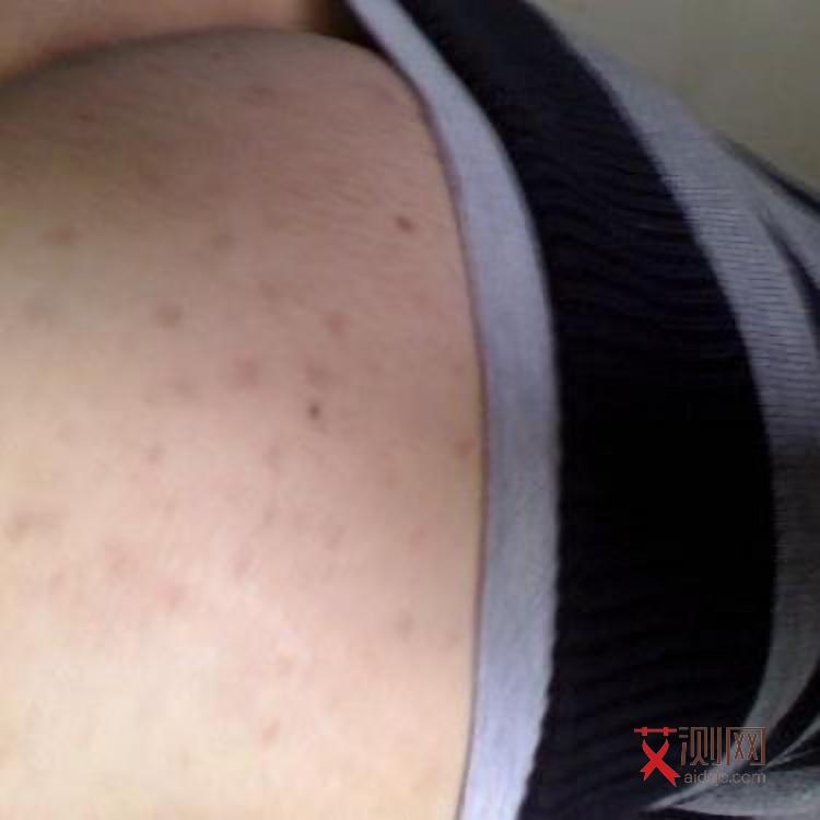 艾滋病男性初期症状和身体反应是什么