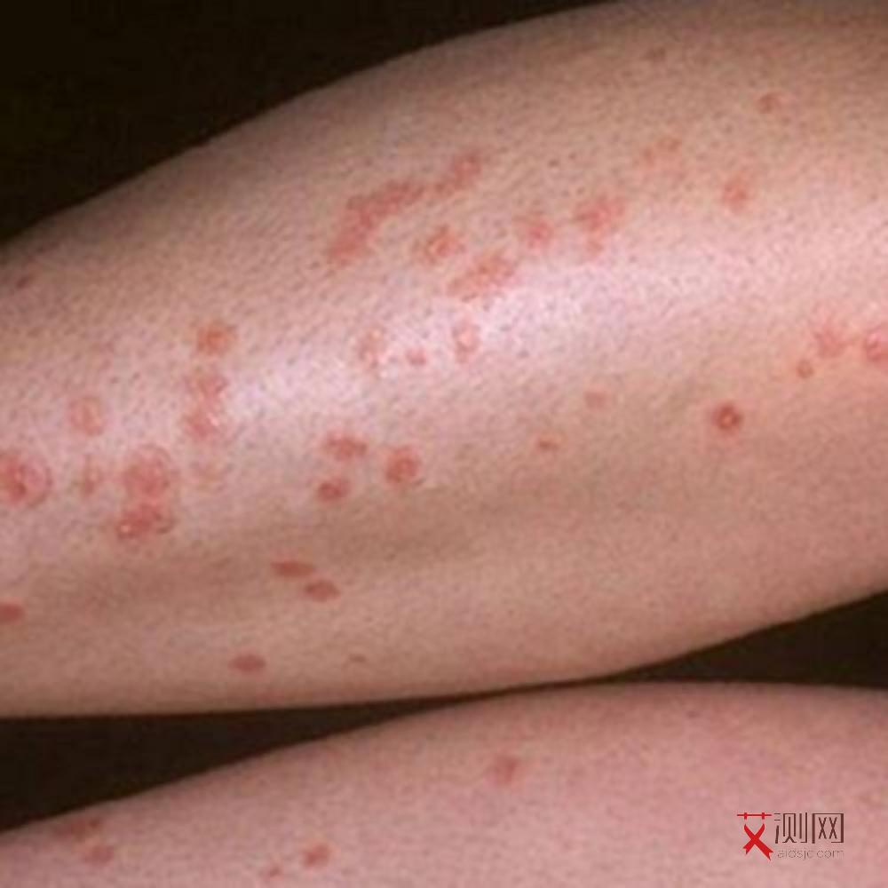 艾滋病人发冷怎么办