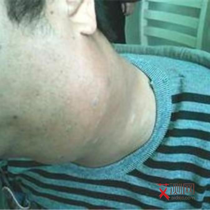 艾滋病病毒感染前期症状