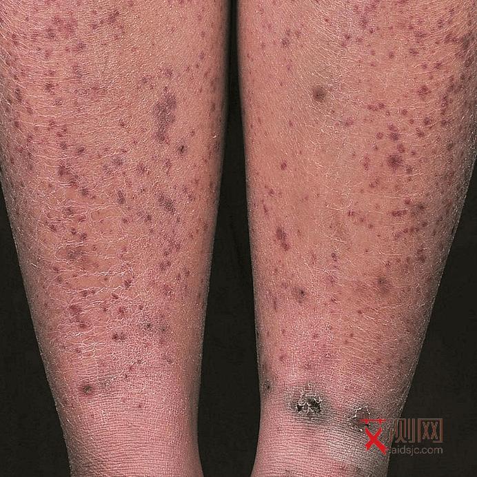 艾滋病前期身体反应是什么样的症状