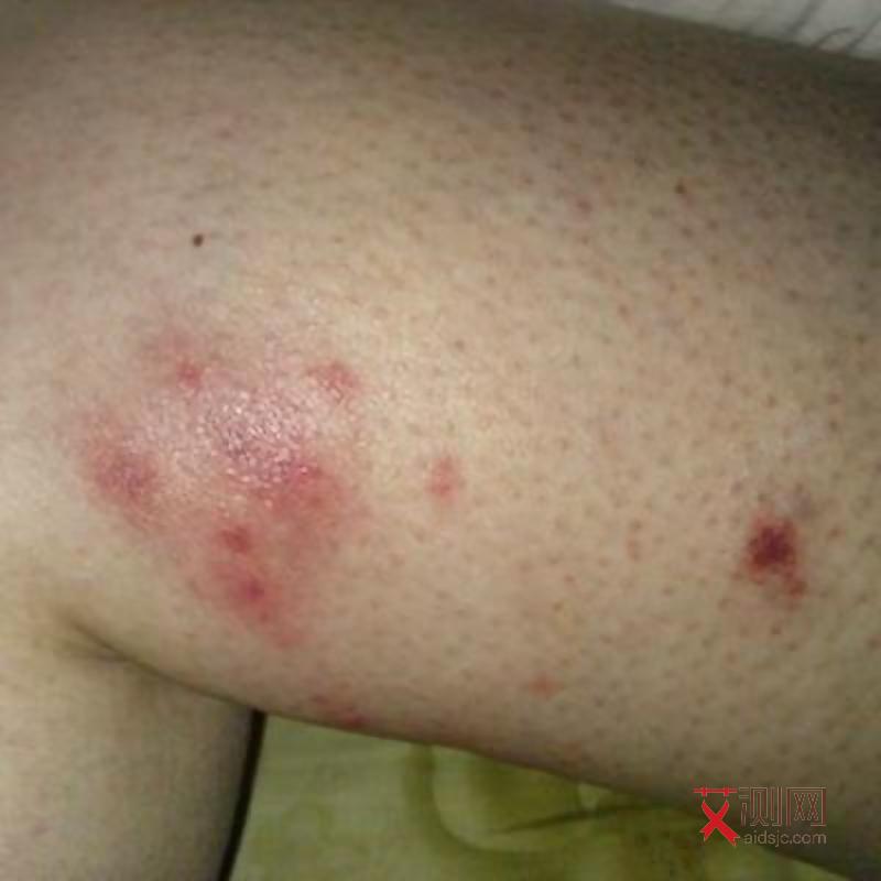 孩子感染艾滋病多久会出现症状呢图片